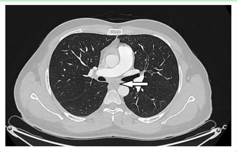 Figure 3 From An Unusual Presentation Of Growing Teratoma Syndrome