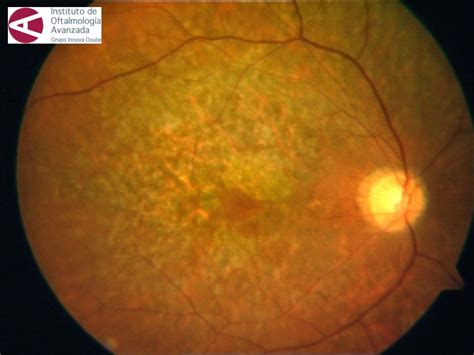 Miranza IOA RETINOSIS PIGMENTARIA