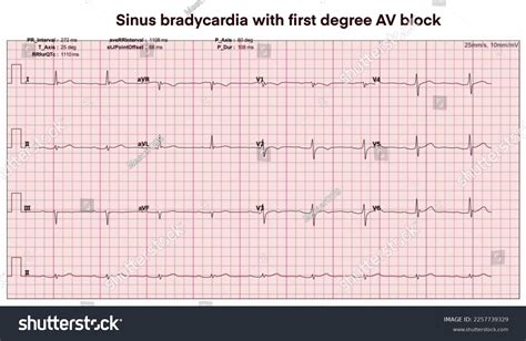 Electrocardiogram Show Sinus Bradycardia First Degree Stock Illustration 2257739329 | Shutterstock