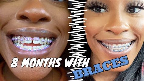 Braces Update 8 Month Check Up Progress Clips And Pics Included