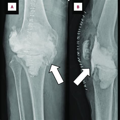 Anteroposterior A And Lateral B Radiographs Of The Right Knee