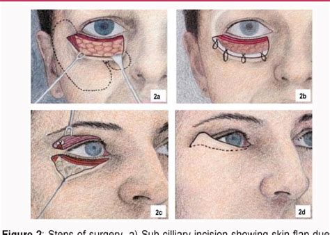 [PDF] Midface Lift through Lower Lid Blepharoplasty Incision | Semantic ...