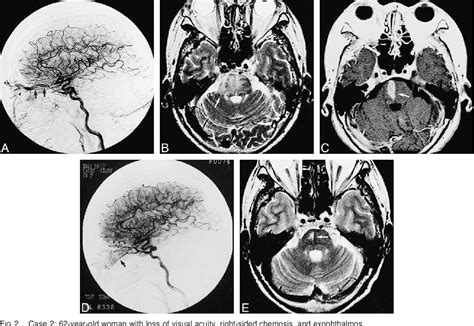 Figure From Report Of Two Cases Sinus With Venous Congestion Of The