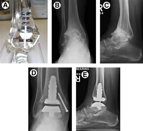 INBONE Total Ankle Arthroplasty Seminars In Arthroplasty JSES