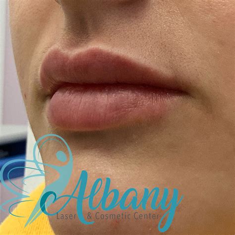 Lip Fillers Case No 1317 Albany Cosmetic And Laser Centre In Edmonton