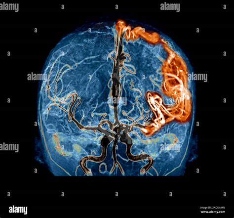 Cerebral Arteriovenous Malformation Coloured Frontal D Computed