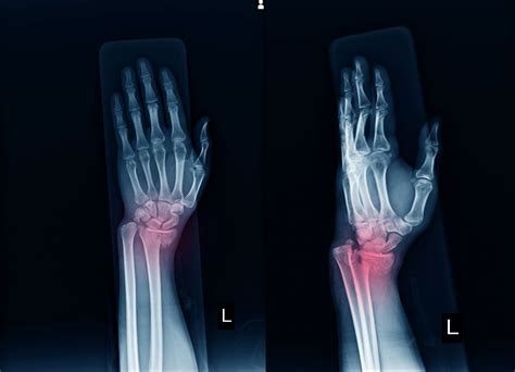 Wrist Fracture Treatment Ladan Hajipour Orthopaedic Surgeon