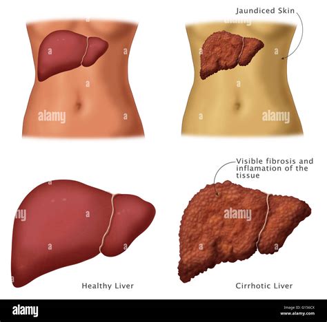 Ilustraci N Que Muestra Un H Gado Sano Izquierda Y Cirrosis Derecha