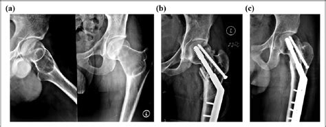 Figure 1 From Review Of 16 Cases Of Aneurysmal Bone Cyst In The Proximal Femur Treated By