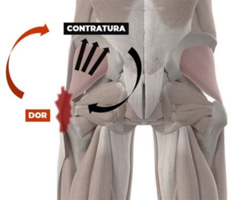 Dor na lateral do quadril Dor Glúteo Exercícios