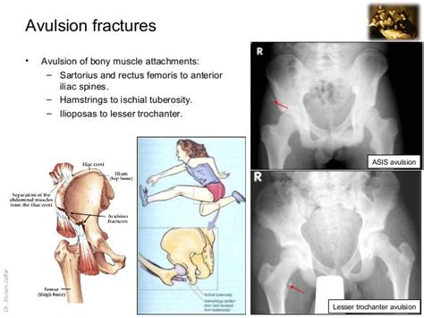 Imaging anatomy avulsion fractures of the hip bone