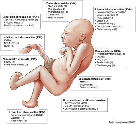 Spectrum of anomalies that may be seen in fetuses with rocker bottom ...