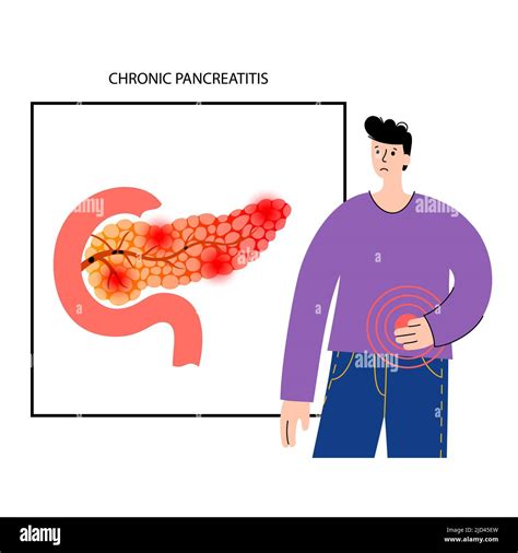 Pancreatitis Cr Nica Ilustraci N Fotograf A De Stock Alamy