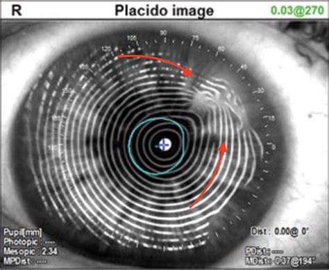 Salzmann’s Nodular Degeneration | Champlain Ophthalmology