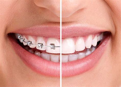 Achieve Your Healthy Smile Resolution With Orthodontic Treatment