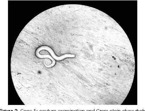 Figure 2 From Strongyloides Stercoralis Hyperinfection Presenting With Symptoms Mimicking Acute