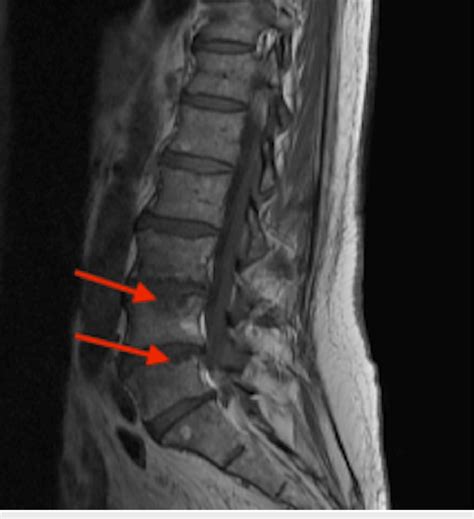 Magnetic Resonance Imaging Depicts Discitis L Vertebrae Red Arrows