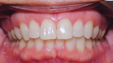 Class Ii Subdivision Right Malocclusion Excessive Overjet Case Gallery