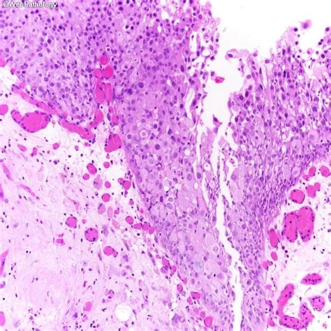 Urothelial Carcinoma In Situ Pagetoid Spread