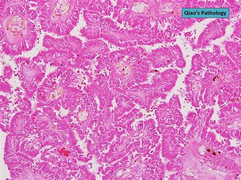 Qiao S Pathology Infarcted Intraductal Papilloma Microsco Flickr