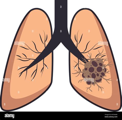 Lung Cancer Isolated Icon Vector Illustration Design Stock Vector Image