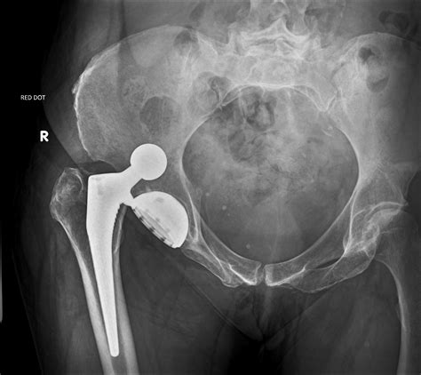 Dislocation Of Hip Replacement Image