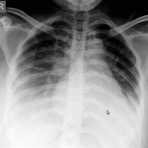 Pneumonia Chest X Ray Diagnosis