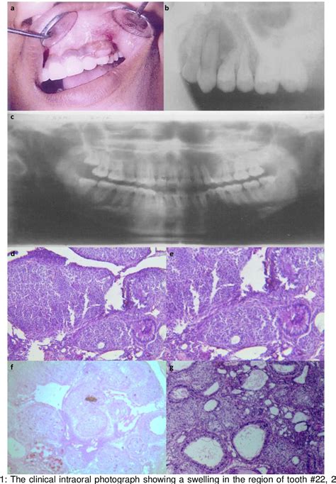 Figure 1 From Adenomatoid Odontogenic Tumour A Case Report And Review