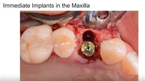 Immediate Mandibular Molar Implant Case Presentation Video Library