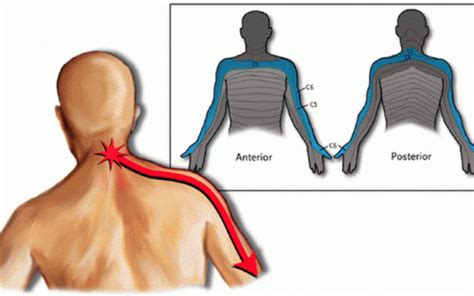 Cervicobrachial Syndrome Pain Runs From Your Neck Down Your Arms