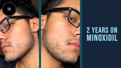 Minoxidil Beard Journey 2 Years Youtube