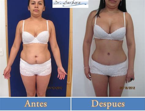 Liposuccion O Lipectomia Tummy Tuck En Qué Casos Se Deben Hacer