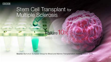 Hsct Stem Cell Transplant For Multiple Sclerosis Youtube