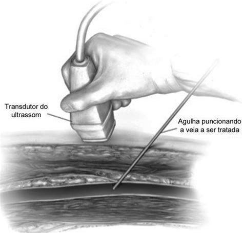 Punção percutânea de veia safena guiada por ultrassom modo B