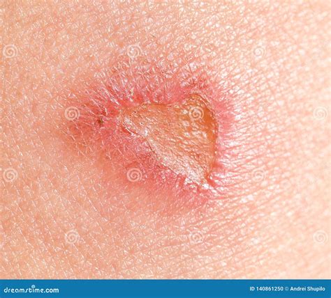 Wound On Human Skin Stock Photo Image Of Injured Texture