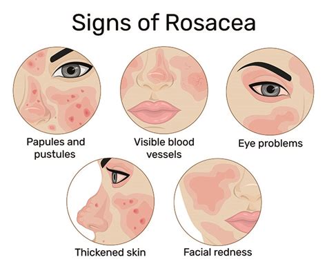 Everything You Need To Know About Rosacea Skinsider