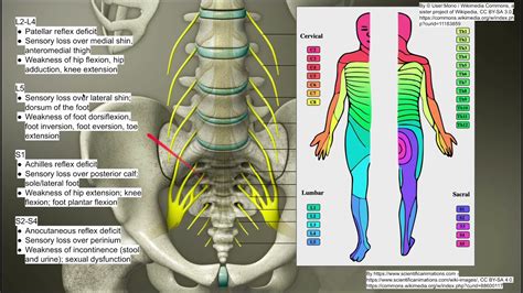 Lumbosacral Radiculopathy Youtube