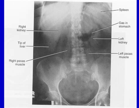 Medical Imaging Renal Flashcards Quizlet