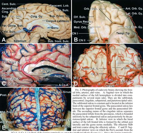 Figure 2 From Surgical Strategy For Distal Anterior Cerebral Artery Aneurysms Microsurgical