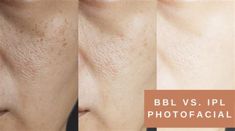 BBL vs IPL: Which Treatment is Right for You? | Vancouver Laser