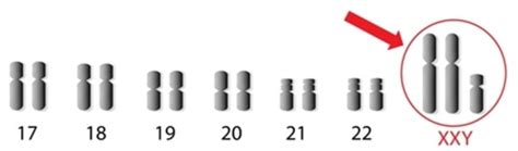 Xxy Klinefelter Syndrome Australian X And Y Spectrum Support Axys