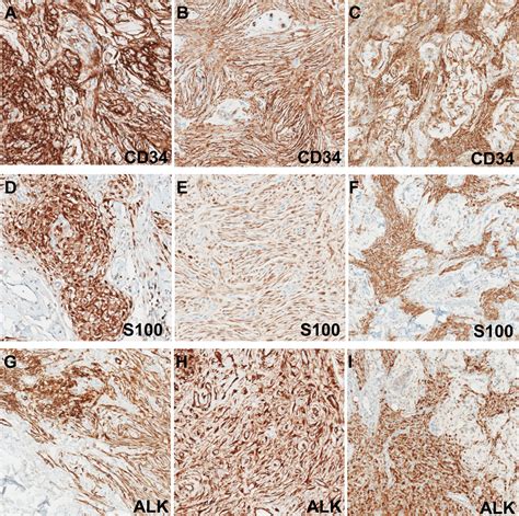 Superficial Alk Rearranged Myxoid Spindle Cell Neoplasm A Cutaneous