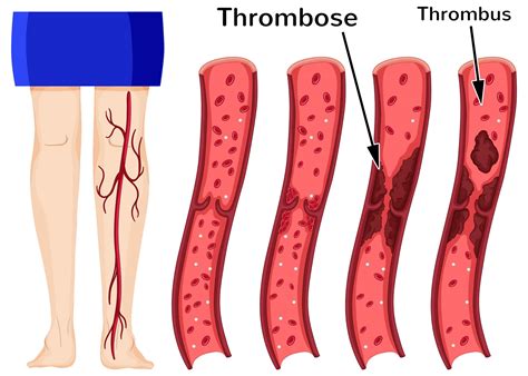 Thrombophlebitis Ursachen Und Symptome