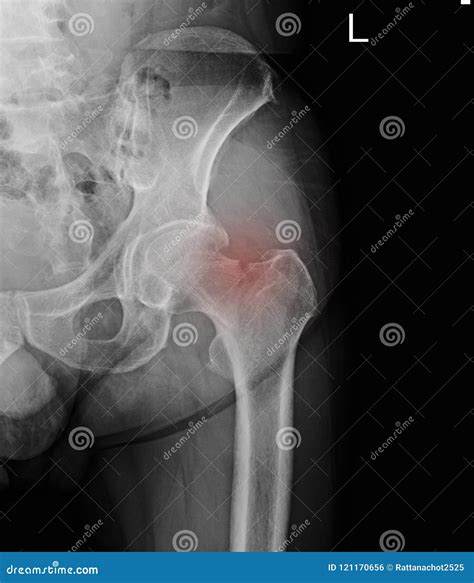 Femur Neck Fracture X Ray