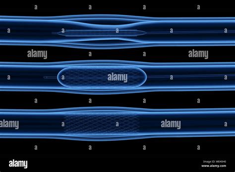 Representaci N D X Ray Procedimiento De Angioplastia Con Bal N Con