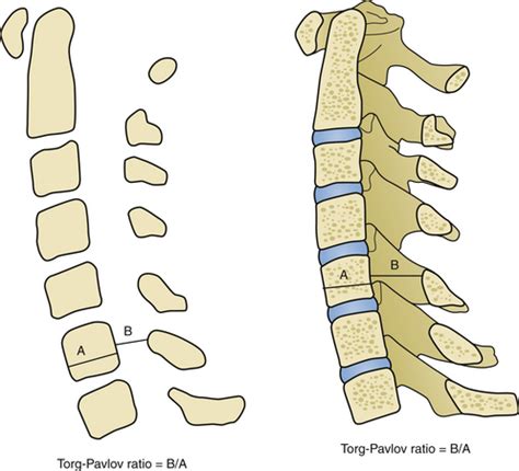 Cervical Laminoplasty Indications And Techniques Neupsy Key