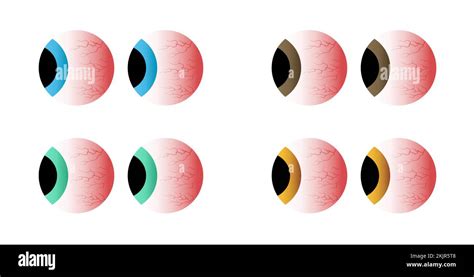 Red Eyes Different Colors Set Sick Stress Sleep Insomnia Disorder