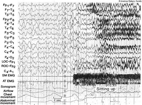 Figure 17 Slow Wave Sleep N3 Contains Electroencephalography