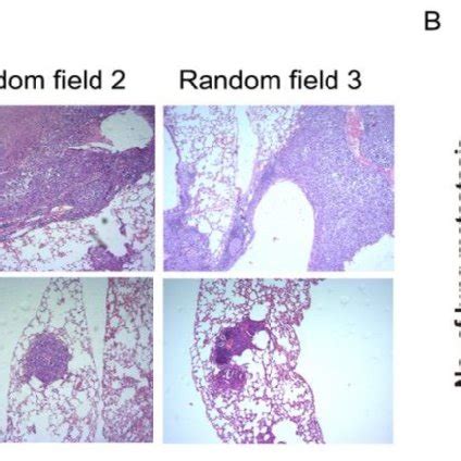 Nkila Suppresses Metastasis Of Hcc In Vivo A Representative Images