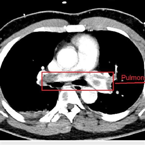 Ct Of The Thorax With Contrast Showing Massive Pulmonary Embolism Download Scientific Diagram